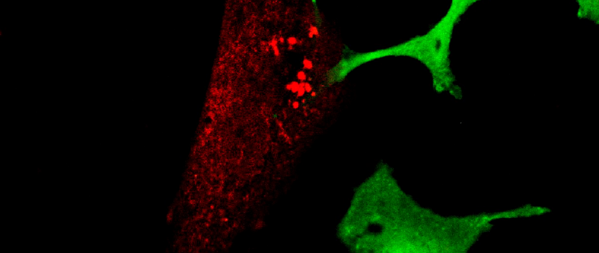 cancer neurons